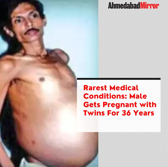 ahmedabadmirror's tweet photo. Rarest Medical Conditions: Male Gets Pregnant with Twins For 36 Years
#malepregnancy #twins #age36 https://t.co/P9Yvs4qUji