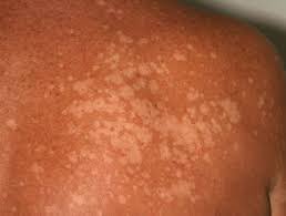 Tejumola__'s tweet photo. This is not eczema, this is tinea vesicolor aka pityriasis vesicolor. https://t.co/X8JNuDCnf7