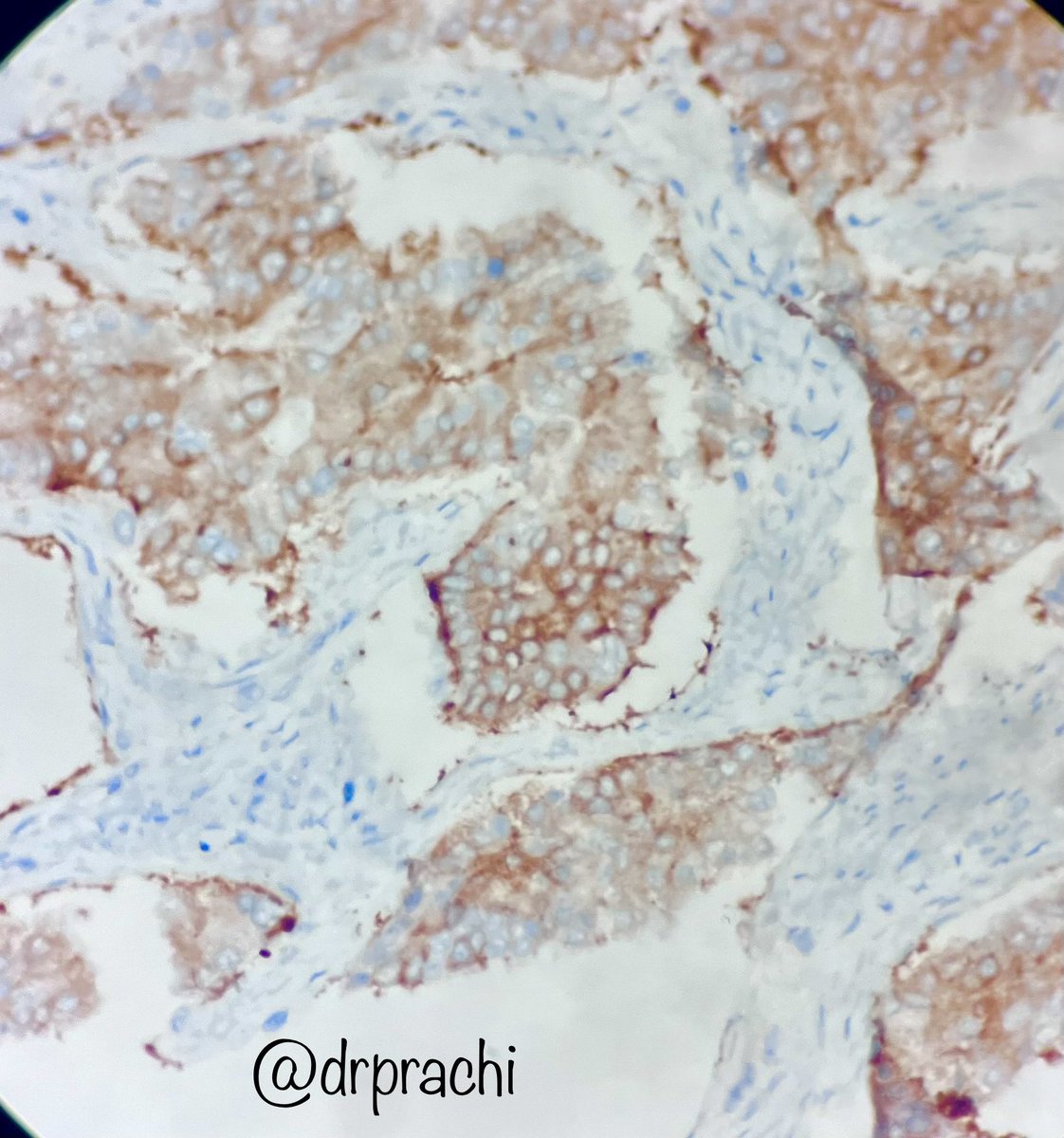 Prachi (@prachipath123) on Twitter photo Trailed the week with this beauty- Large cell NEC of bladder with marked intestinal metaplasia <a href="/PathTweetAward/">Educational Pathology Tweet Award</a> <a href="/DrGeeONE/">Olaleke Folaranmi</a> <a href="/VHNguyenMD/">Van-Hung Nguyen MD 🇺🇦🌻</a> <a href="/archibhat3/">Archana bhat</a> <a href="/mathuraiims/">Sandeep Mathur</a> <a href="/VijayPatho/">Vijay Shankar S</a> <a href="/Pathoutlines/">PathologyOutlines.com</a> <a href="/TurkJPath/">Turkish J Pathology</a> <a href="/pathologistmag/">The Pathologist</a> Trailed the week with this beauty- Large cell NEC of bladder with marked intestinal metaplasia <a href="/PathTweetAward/">Educational Pathology Tweet Award</a> <a href="/DrGeeONE/">Olaleke Folaranmi</a> <a href="/VHNguyenMD/">Van-Hung Nguyen MD 🇺🇦🌻</a> <a href="/archibhat3/">Archana bhat</a> <a href="/mathuraiims/">Sandeep Mathur</a> <a href="/VijayPatho/">Vijay Shankar S</a> <a href="/Pathoutlines/">PathologyOutlines.com</a> <a href="/TurkJPath/">Turkish J Pathology</a> <a href="/pathologistmag/">The Pathologist</a>