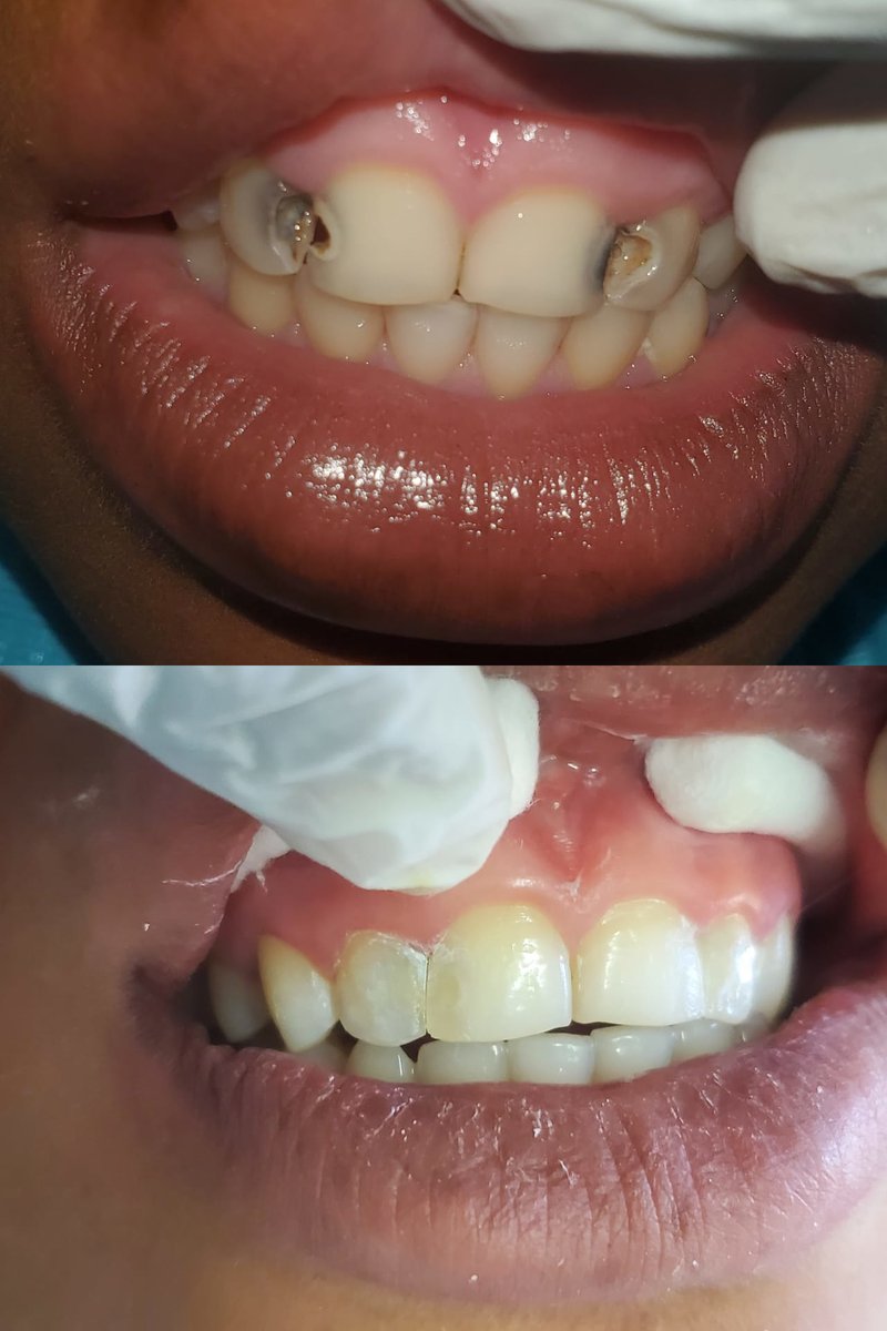 Happy client= Happy us #customerreview 
Check-Up K150.
Filling K400 per tooth.
Locations: Lusaka, Kabwe, Ndola, Kitwe & Chipata
Call/WhatsApp: 0976942794 To Book An Appointment Today
Our Mission: A Perfect Smile Zambia