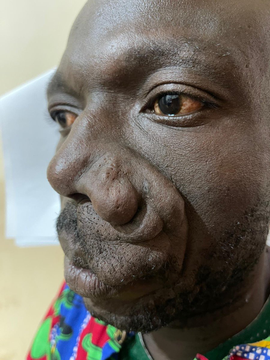 Just one example of the dozens of life-changing operations completed during Team Surgical Relief’s time in Ghana is this excision of a nasal mass.

These transformative procedures would not be possible without your support!

#OperationInternational #ThisIsHowWeOperate