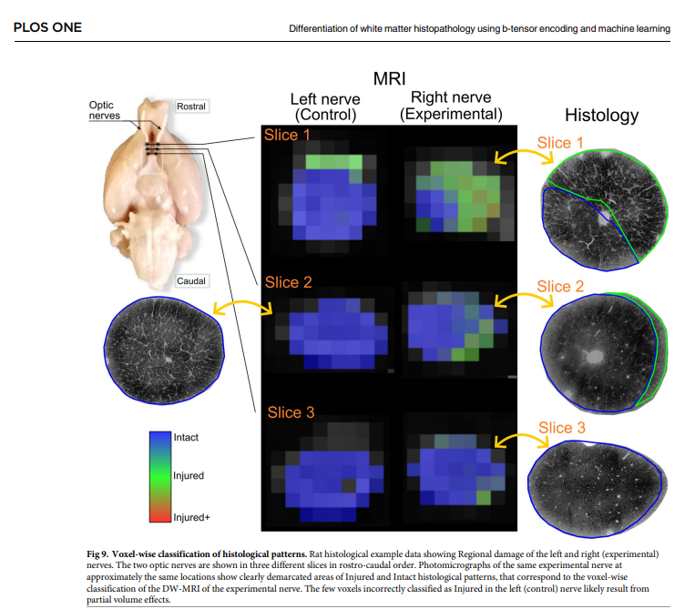 lanirem_unam's tweet photo. New paper out, led by @RRios466 , now in @PLOSONE . Multidimensionally-encoded DWI and machine learning for differentiation of white matter histopathology. Work performed at @UNAMINB in collaboration with @cimatoficial .  https://t.co/gCIHLy8KCt https://t.co/KfV92irtFr