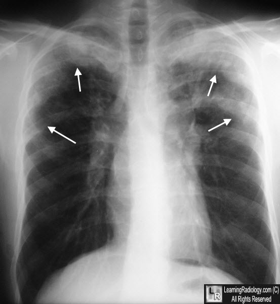 CXR shadowing and eosinophilia → ?Loffler's syndrome

thought to be due to parasites such as Ascaris lumbricoides causing an alveolar reaction. 

- highly responsive to steroids