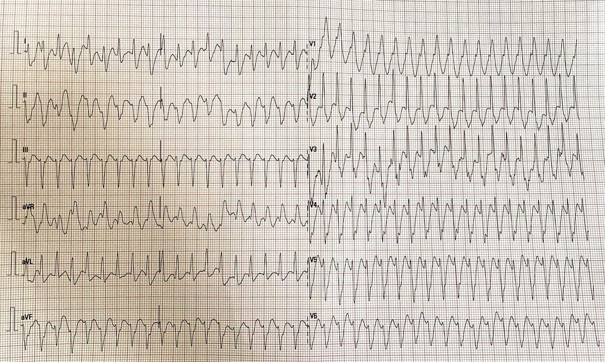 Prior ASD operation, normal coronary…
SVT or VT?  #EPeeps