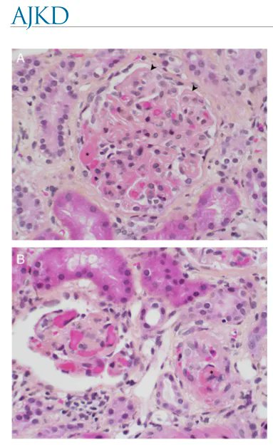 Renal Thrombotic Microangiopathy: A Review 

buff.ly/3IbOoqD  (FREE)

<a href="/CPQMD/">Chris Patriquin (he|him)</a> <a href="/ReichHeather/">Heather Reich</a> <a href="/UofTNephrology/">U of T Nephrology</a>