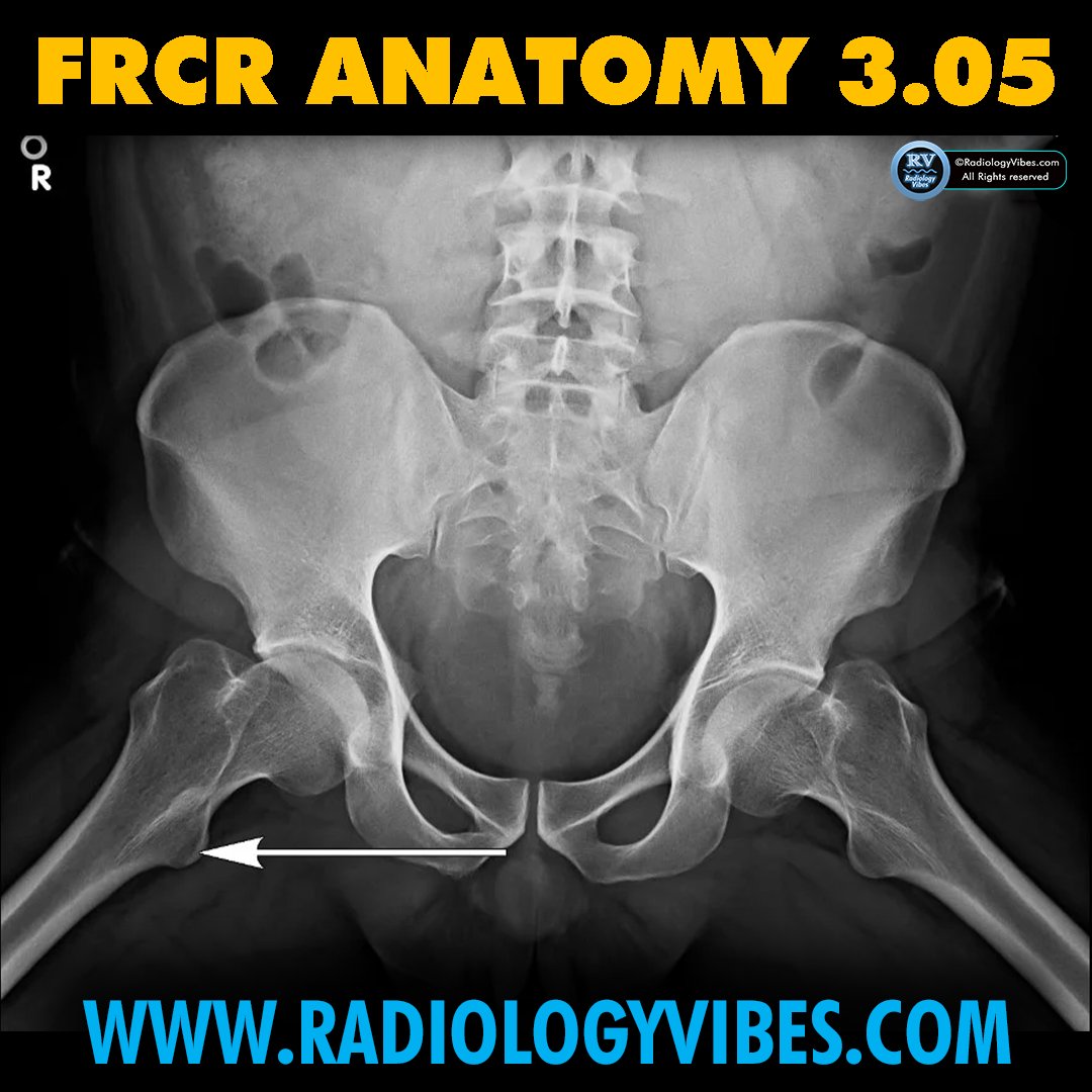 FRCR Anatomy 3.05: Name the arrowed structure

#radres #FOAMrad #FRCR #radiology #anatomy #MedTwitter #radtwitter #FRCRanatomy

@Radiology_Vibes @anatomy4frcr @_the_SRT