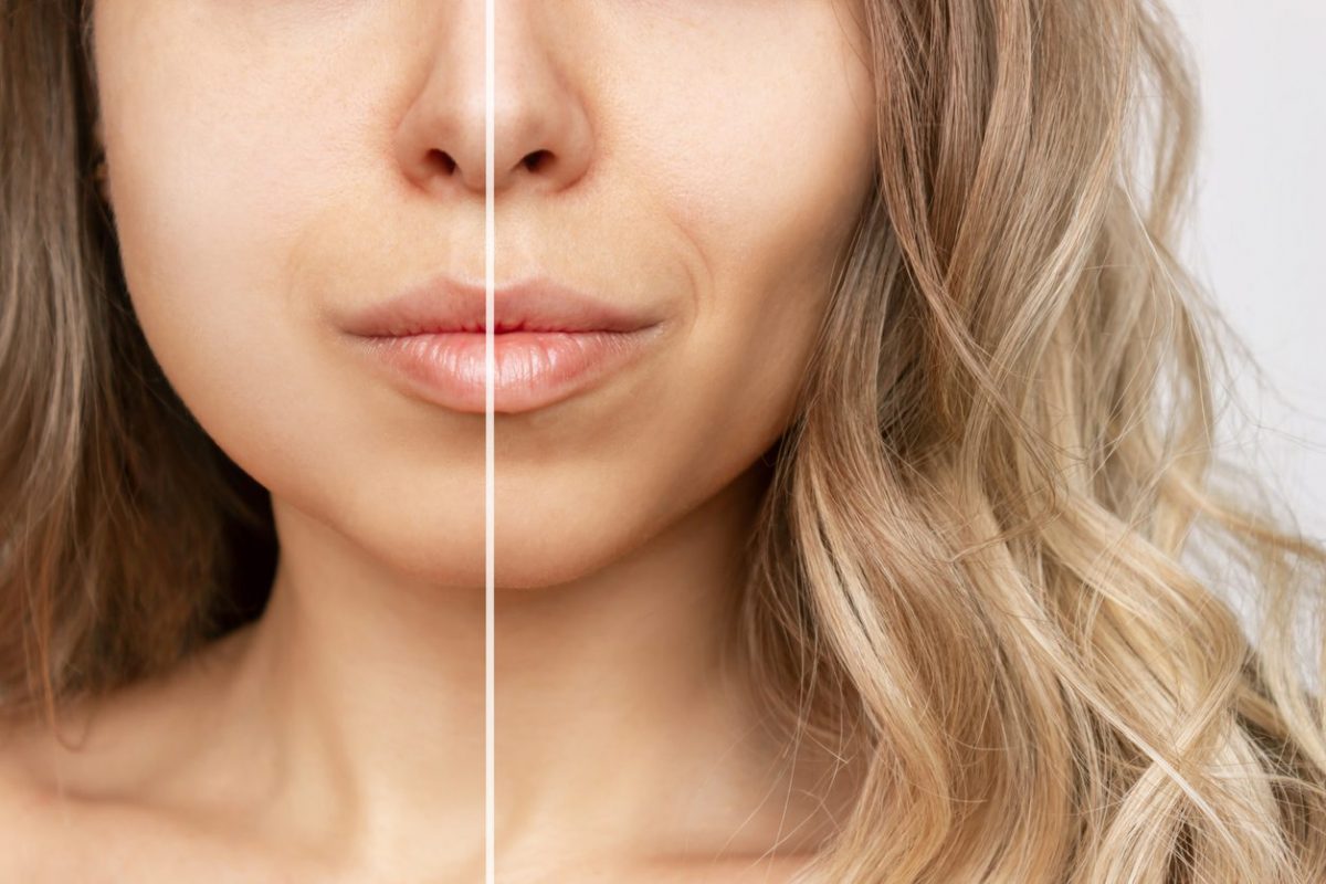 Can Fat Transfer to the Face Solve Your Volume Needs? via @Yegfit dlvr.it/Sr9kkF