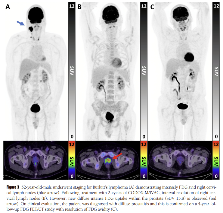 DrMHofman's tweet photo. FDG PET/CT too often ignored: a game changer for advanced disease. Enhances disease site assessment, helps in🎯personalized theranostic treatments. Say goodbye to 'one-size-fits-all'! 💥
Nice review by Dr Sutherland:
https://t.co/r8zsw9mD5h https://t.co/yRXhLaZMu9
