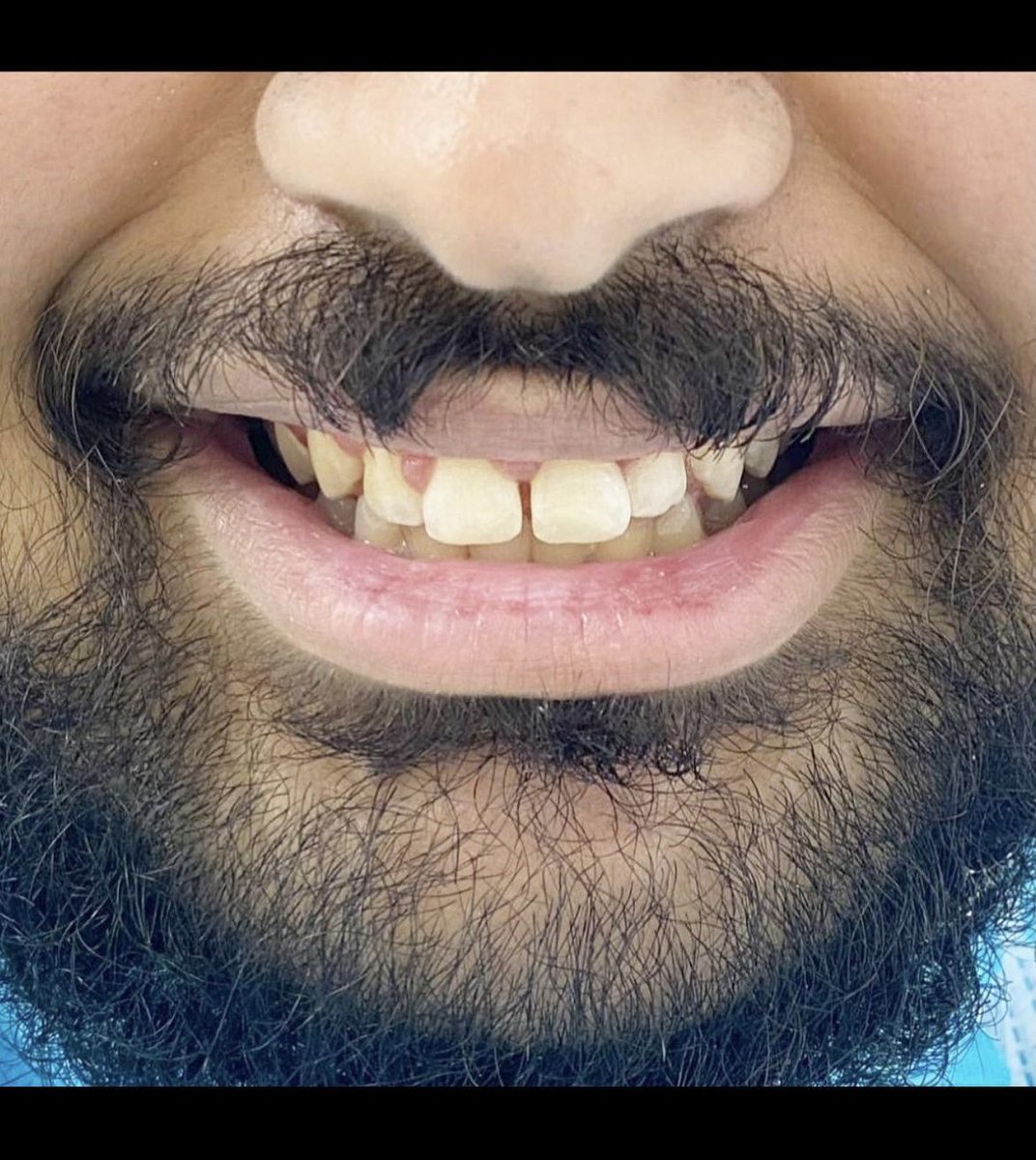 2Nadeen2's tweet photo. This Patient suffered from Dentophobia
Never went to the Dentist before !! 
Had a dental trauma from the childhood !
Needed multiple visits to retain his trust back ❇️
both teeth #11,#21 (2 Class IV ) were restored at the same clinical visit ,
Patient’s Comments were the best 😍 https://t.co/62Xp5YFBMd