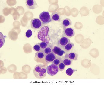 @EletrebiMohamed @nihardesai7 Suckling erythoid precursors around a 'Nurse cells'.
They are erythroid precursors arranged around a hemosiderin laden macrophages to receive iron needed for hemoglobin synthesis. commonly seen in a regenerating bone marrow aspirate/in children
DD 
LHH
Metastatic neuroblastoma