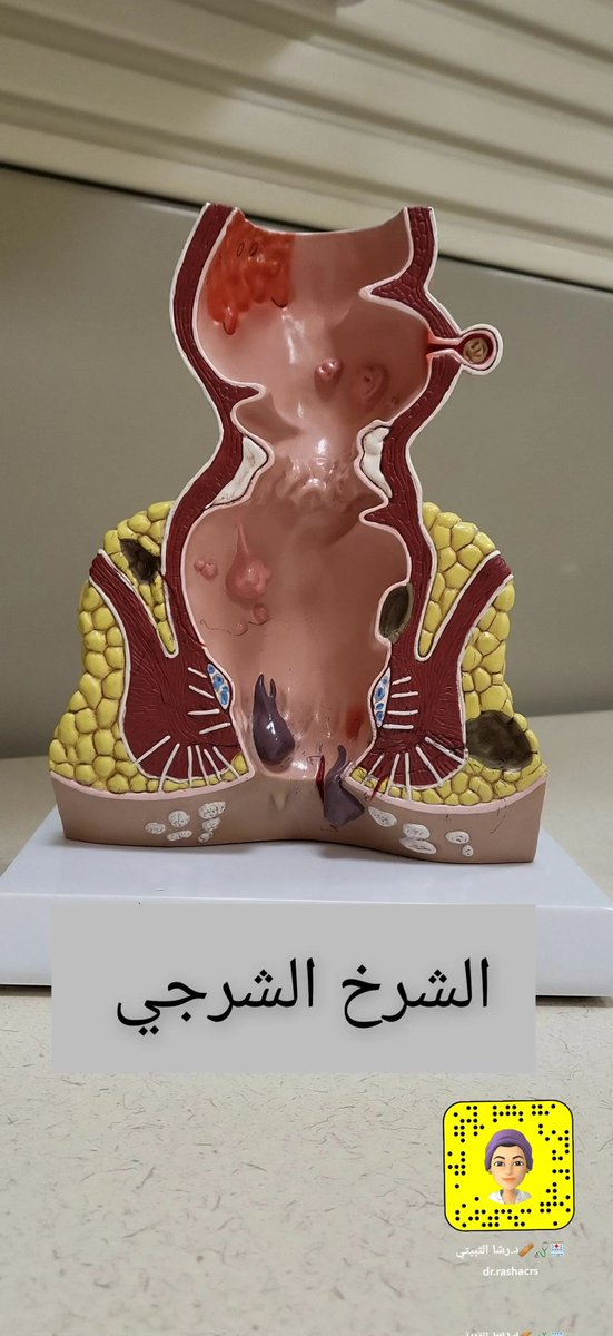 محتوى مبسط عن الشرخ الشرجي وطرق العلاج .. #تثقيف_صحي #توعية_صحية #اسأل_طبيبك <a href="/rattibha/">Rattibha رتبها</a> <a href="/DoctorsWorld_/">تجمع أطباء العالم</a>