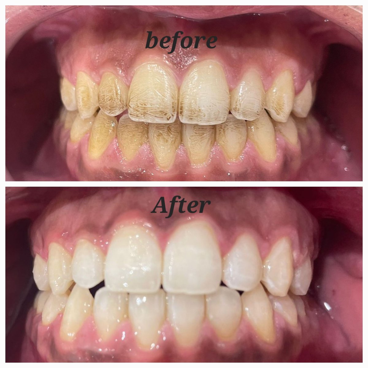 Robaaloraini's tweet photo. بالتنظيف فقط يُصنع الفرق 
#تنظيف
#Prophy #teeth #dentistry https://t.co/2lHiisntXy