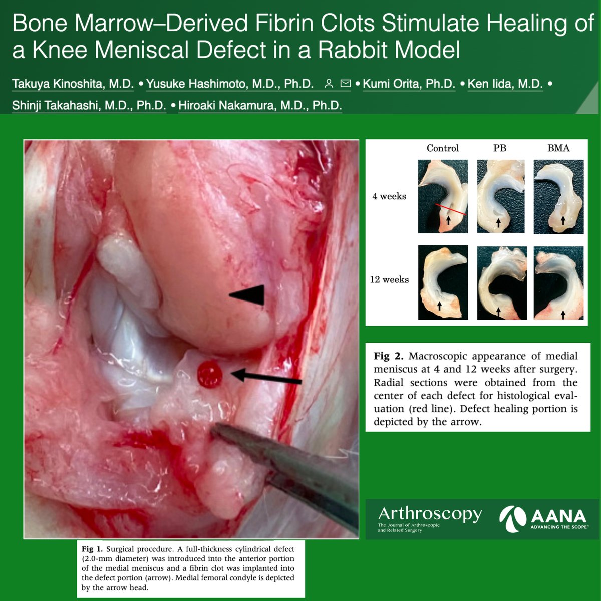 Bone marrow-derived fibrin clots stimulate healing of a meniscal defect in a rabbit model

ow.ly/wPGt50OMrtX