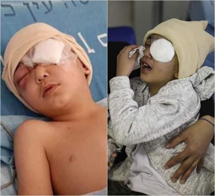 Palestinian 5-year-old child loses his eye after being shot by the lsraeli occupation forces near Nablus city.