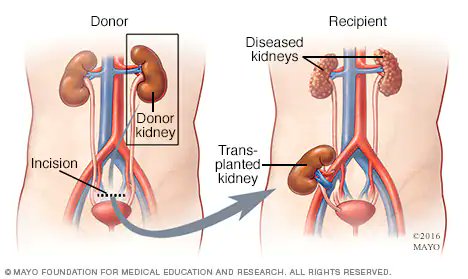 🧵 On the one year anniversary of Dobbs, let's walk through a hypothetical.

Say someone needed an organ transplant to live.

Now let's say that person has a rare profile, and you are the only person on Earth with whom they match.

Are you OBLIGATED to give them the organ?

(1/8)