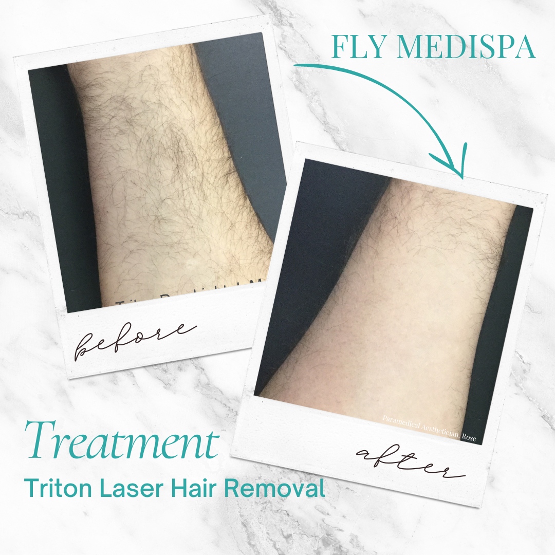 Who's ready for smooth skin about 70 times faster? 🤩 Laser hair removal is safe for all skin types and so much quicker than traditional lasers! Get ready to say goodbye to shaving and say hello to superior smoothness - book today! #LaserHairRemoval #NoMoreShaving #SmoothSkin