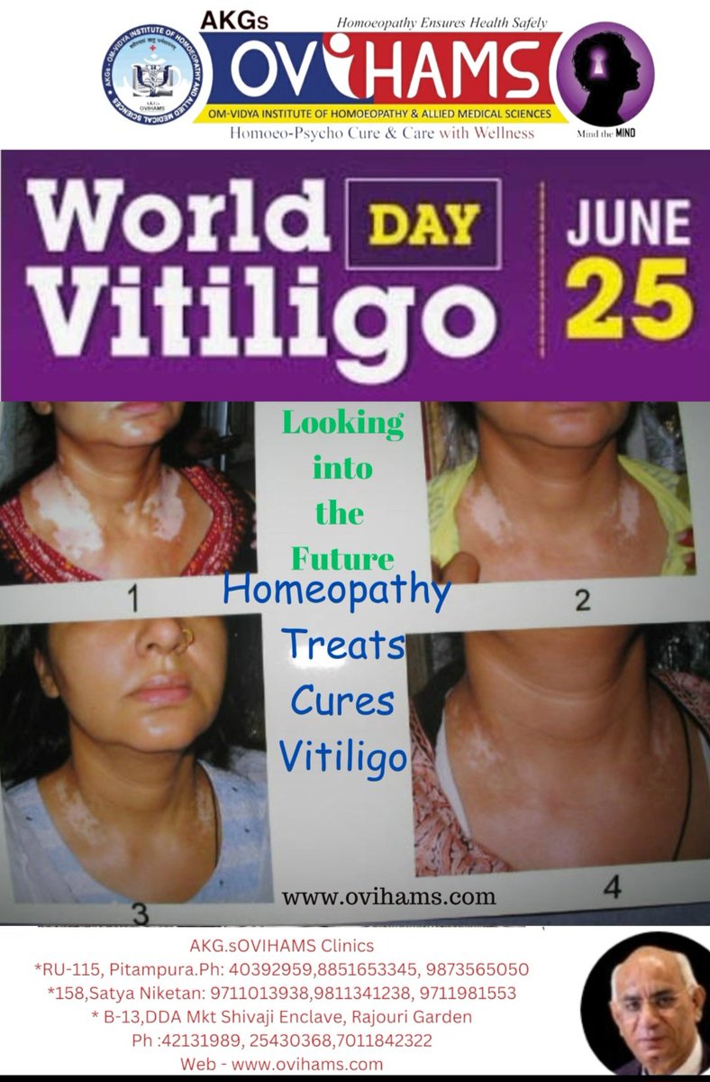AKGsOVIHAMS's tweet image. #WorldVitiligoDay June 25.
#Vitiligo or #Leucoderma is treated effectively wid #Homeopathy. It's more of a #Cosmetic stigma &amp;amp; #Psychological.
At #AKGSOVIHAMS  
Vitiligo Looking into the Future - Homoeopathy Treats &amp;amp; Cures it.
 ovihams.com/ailments/leuco…
 youtu.be/w7qKD--QBm8