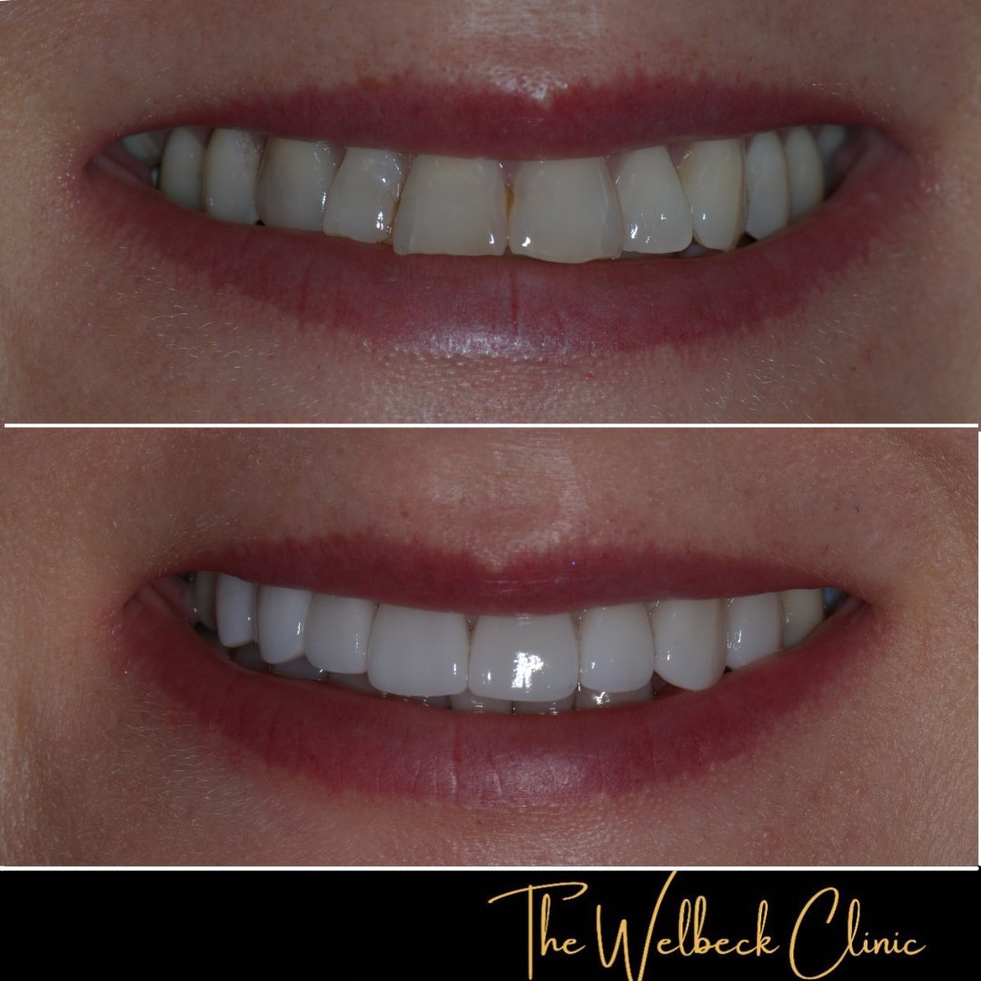 This patient attended to see Dr Ilaty unhappy with the chipped edges of the front teeth. 
8 upper veneers were placed to give this patient an improved smile she was happy with.   
To book a consultation contact us on 0207 486 8100
 #patients #veneers #teeth #smile #makeover