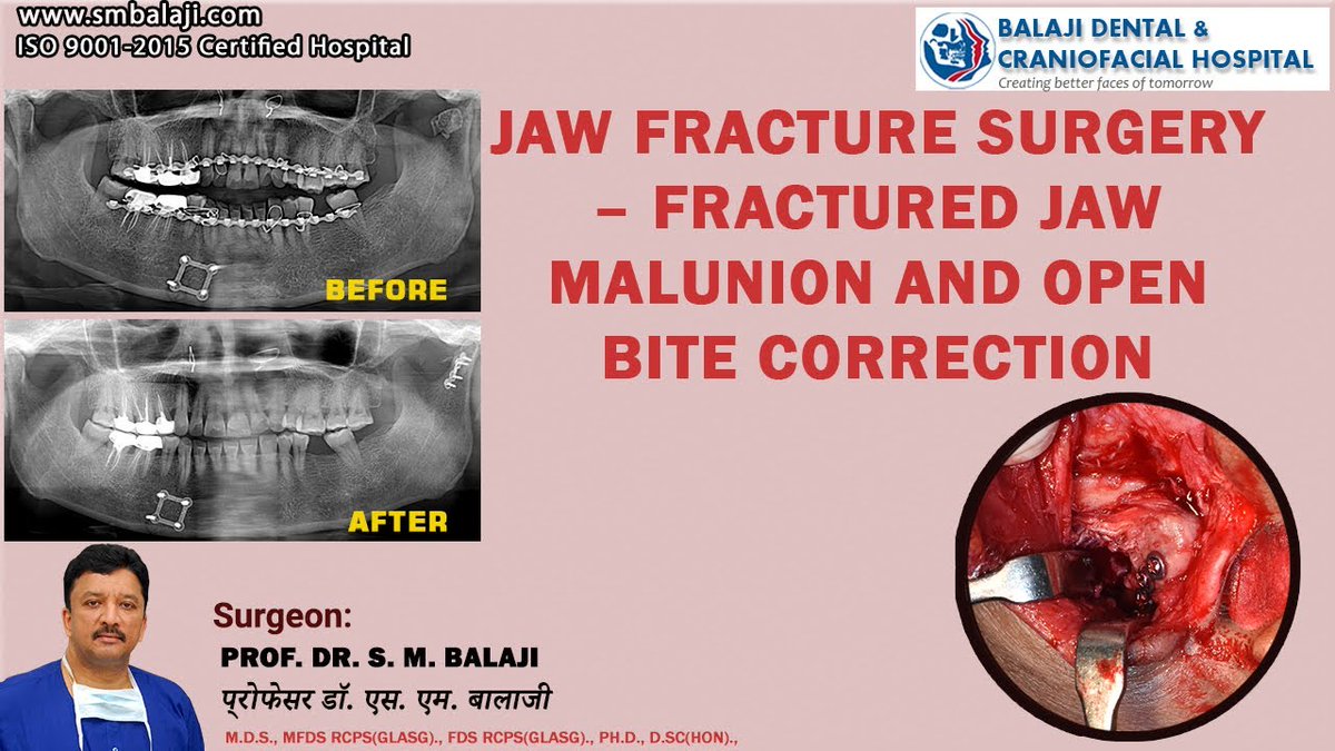 balajidental's tweet image. Jaw Fracture Surgery – Fractured Jaw Malunion and Open Bite Correction 
youtu.be/KcYL8j6-PFU 
#JawFractureSurgery #OpenBite #OpenBiteCorrection #MaxillofacialSurgery #MaxillofacialSurgeon #smbalaji #balajidental