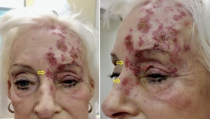 A 70 yo female p/w painful vesicular rash affecting the left forehead& left eye; 3 days before the onset of rash,a tingling sensation was felt over the forehead. What's the diagnosis?
#MedTwitter #medicine #MedEd #Clinical #spotdiagnosis #eyetwitter