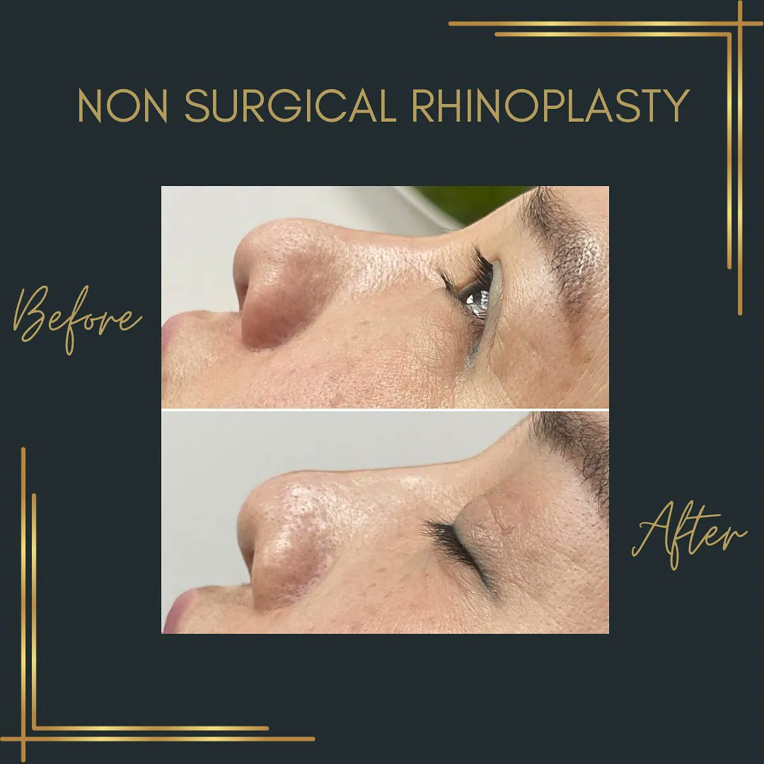 Non-Surgical Rhinoplasty ✨

It always amazes me how such small subtle changes can have big impacts 💚

Treatments such as non-surgical rhinoplasty are ideal if you’re looking to smooth out any little lumps or bumps.
#nonsurgical #nonsurgicalrhinoplasty #rhinoplasty