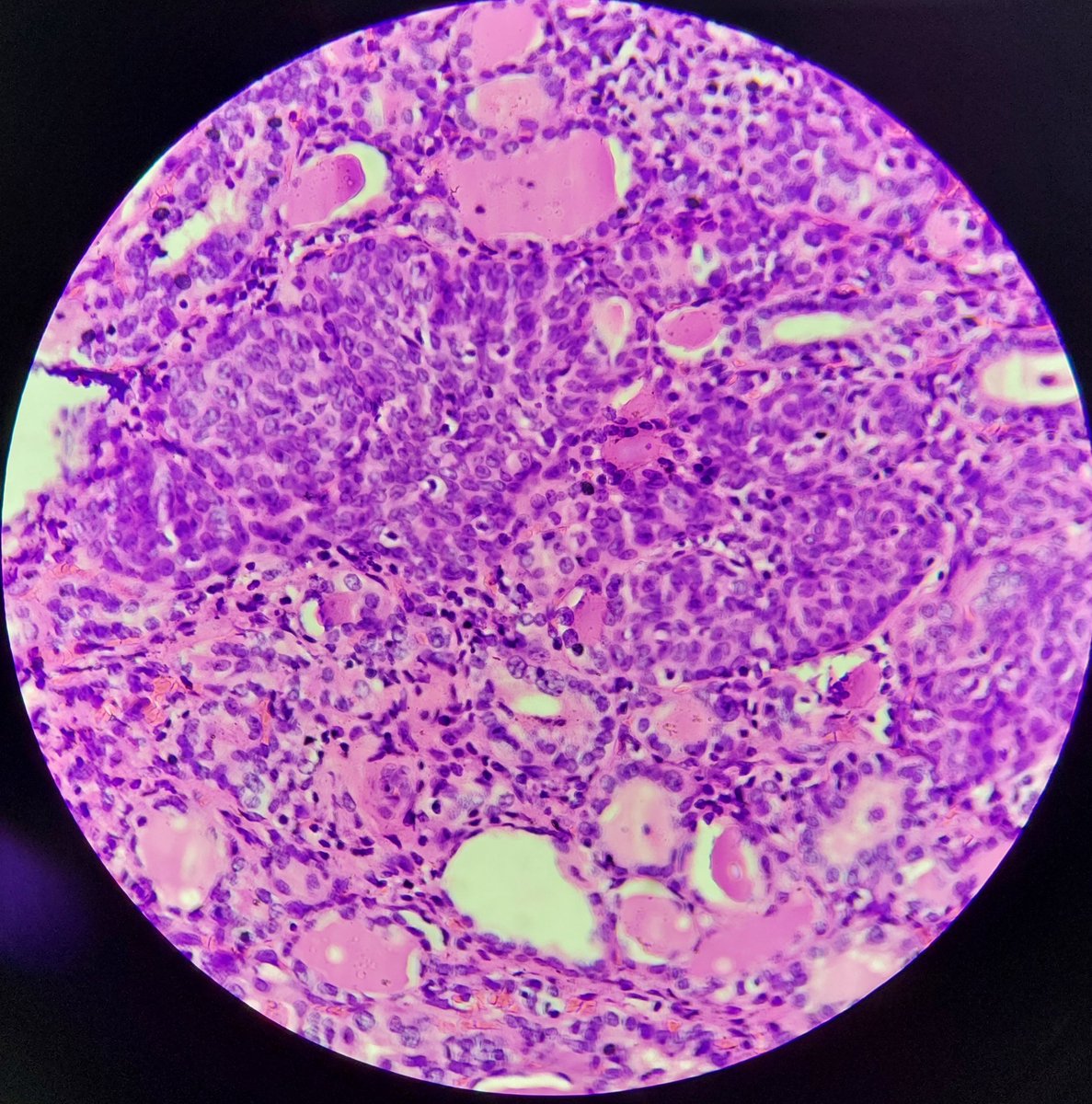 padmapathology1's tweet image. Solid cell nests in thyroid
⭐Small (&amp;lt; 1 mm) interfollicular clusters of epithelial cells resembling squamous/ transitional epithelium.
⭐ Remnants of ultimobranchial body
#pathtwitter
#endopath #pathresidents