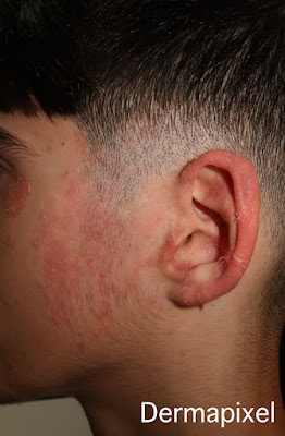 SCPed's tweet photo. 🧐"Picores de peluquerías", cas de dermatologia pediàtrica al blog #Dermapixel de @rosataberner https://t.co/lwA4PvkLHS https://t.co/ii3K8wagsl