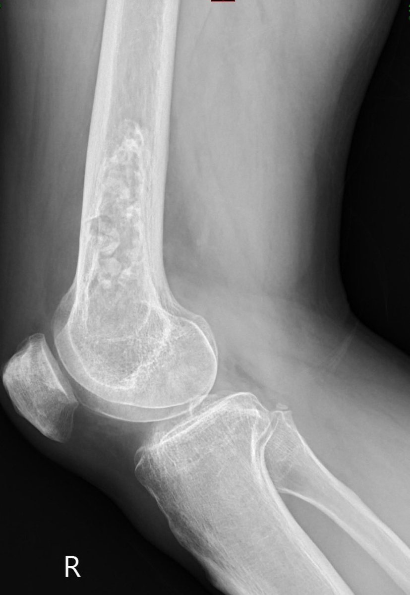 A 30 year old man presented with leg pain. X-rays of the leg showed an intramedullary lesion. What is the likely diagnosis? (Image @Radiopaedia, case by Zeeshan Ghias Khan) #MedEd #FOAMrad