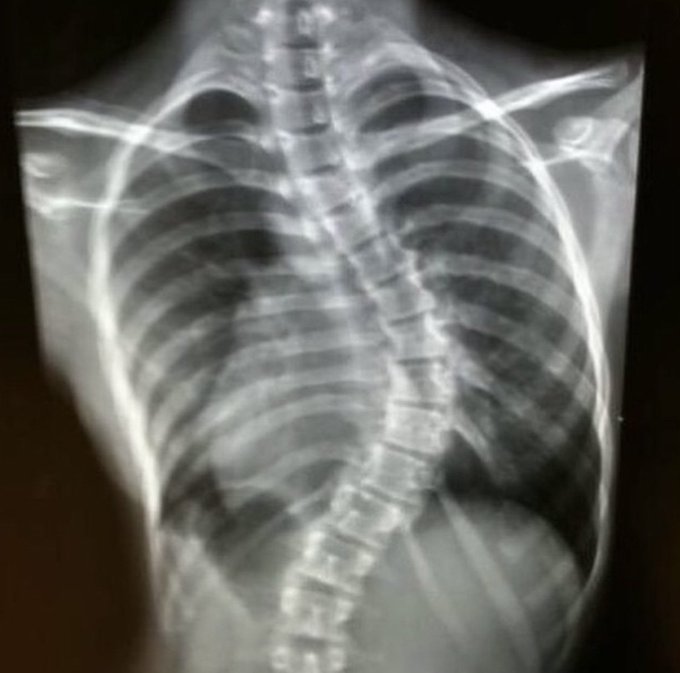 Since it&rsquo;s national scoliosis awareness day, I thought I&rsquo;d show you all how fucked my back was 🤗 (those<a href="/tag/mvsales"class="tags"><span>#mvsales</span></a>