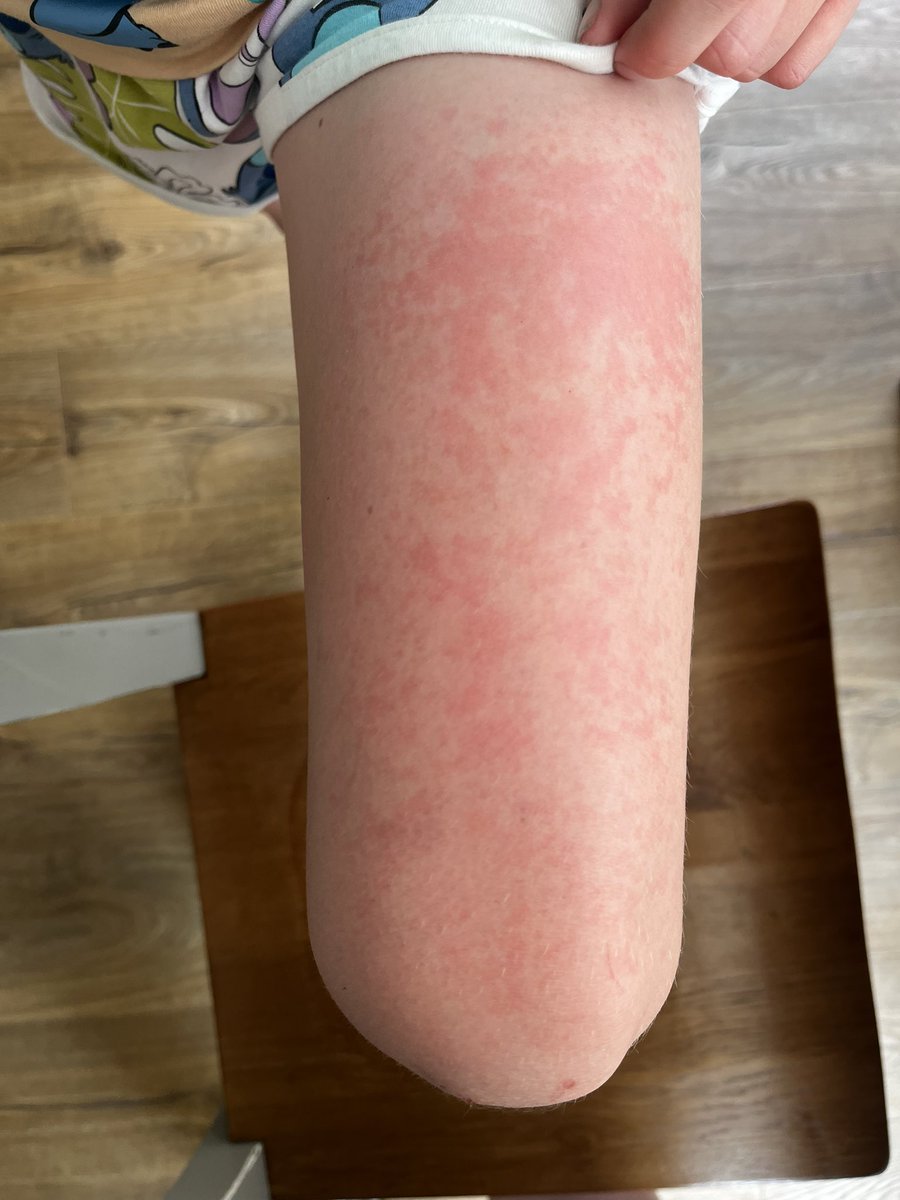 JoAdlam82's tweet photo. @BootsUK this is a reaction from Soltan kids. Any idea why? Is there an alternative product that you could suggest? https://t.co/rSWREF3ZpT