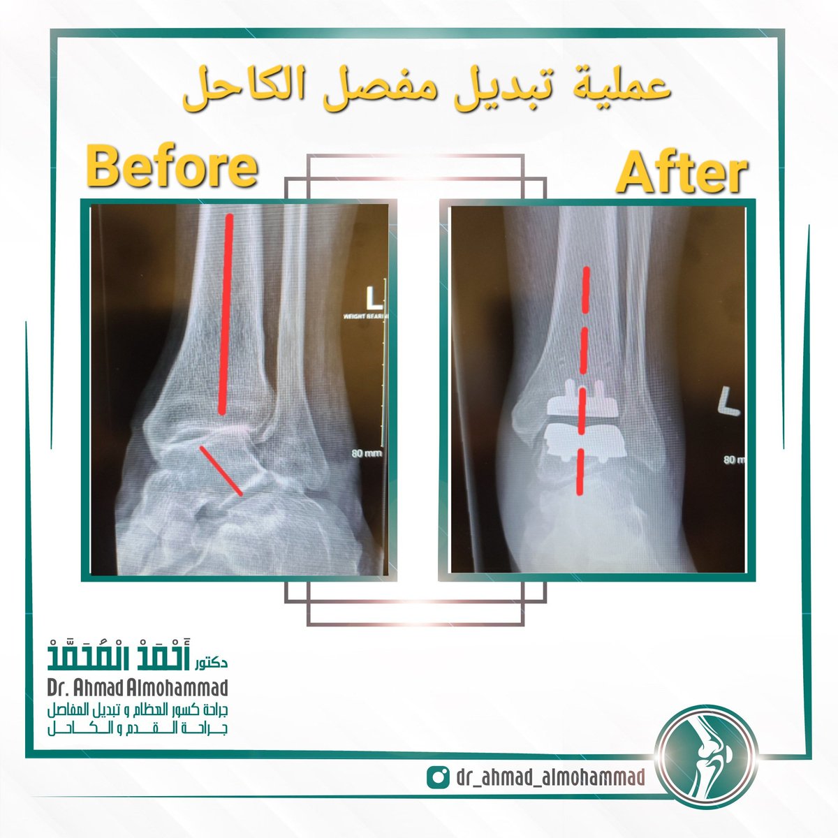 dr_aalmohammad's tweet photo. خشونة مفصل الكاحل هي تآكل للغضروف المفصلي للكاحل و غالبا تكون نتيجة لإصابات أو صدمات 

 يتم التشخيص في المقام الأول من خلال الصور الشعاعية للكاحل.

 يمكن أن يكون العلاج غير جراحي أو جراحي اعتمادًا على عمر المريض ومتطلبات نشاط المريض وشدة الخشونة و انحراف الكاحل

1/2 https://t.co/os9N2H4UGB