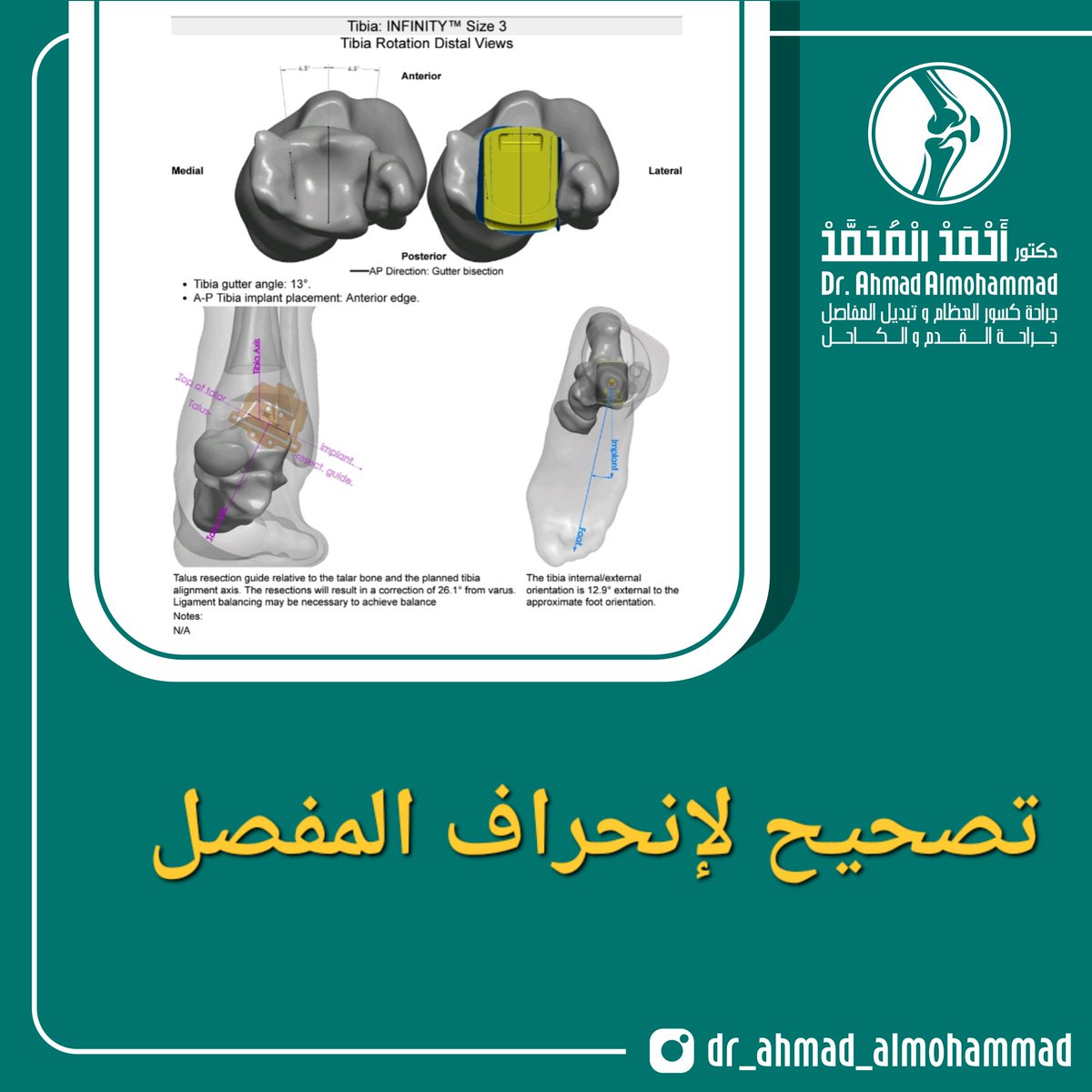 dr_aalmohammad's tweet photo. ولإجراء عملية تبديل مفصل الكاحل نقوم بوضع خطة علاجية و عمل اشعة مقطعية ثم ارسالها الى المصنع ثم يتم صناعة مرشد خاص للمريض 

وتتميز عملية تبديل مفصل الكاحل عن عملية الدمج ان مدى الحركة  يكون اعلى
 أما عملية الدمج يفقد المريض الحركة في المفصل
2/2 https://t.co/a5zSoq4Xv0
