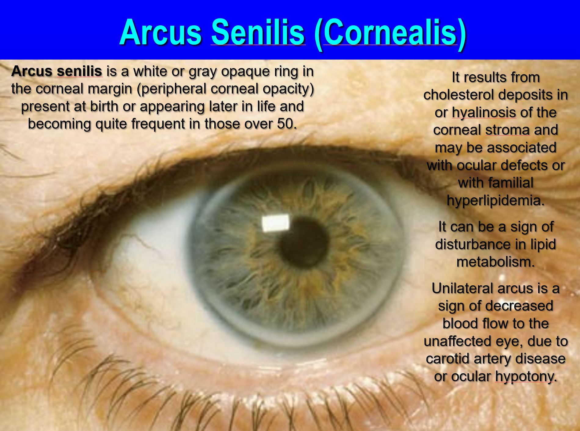 Corneal Arcus: What Is It, Causes, Diagnosis, And More, 46% OFF