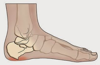 كيف تتخلص من الم #مسمار_العظم
الم كعب القدم الصباحي..تيبس القدم 
من اعراضه
 اما الم، عوار تيبس الكعب صباحا لمده قصيره او الم بين متوسط الى شديد خلال اليوم. 
مسمار القدم او مسمار اخيليس مش هو سبب الم القدم الصبح وعدم المقدره على المشي.
من زمان علمونا غلط افهم قصته جيدا
تابع٢