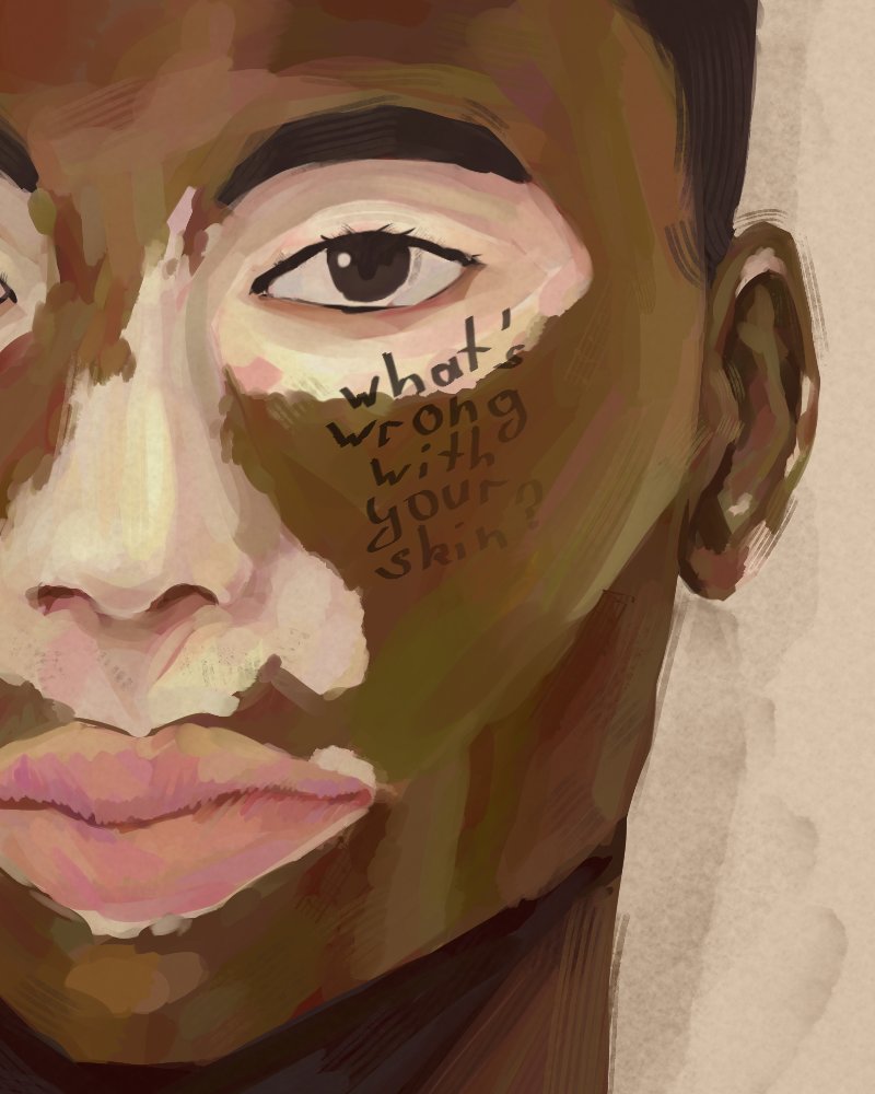 #vitiligo