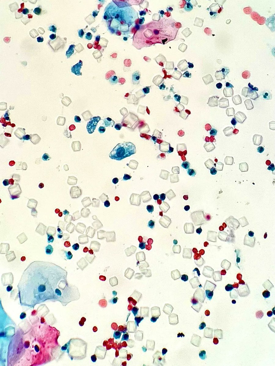 Voided urine containing what type of crystals? Answer: kikoxp.com/posts/14924 #PathArt #CytoPath #PathTwitter