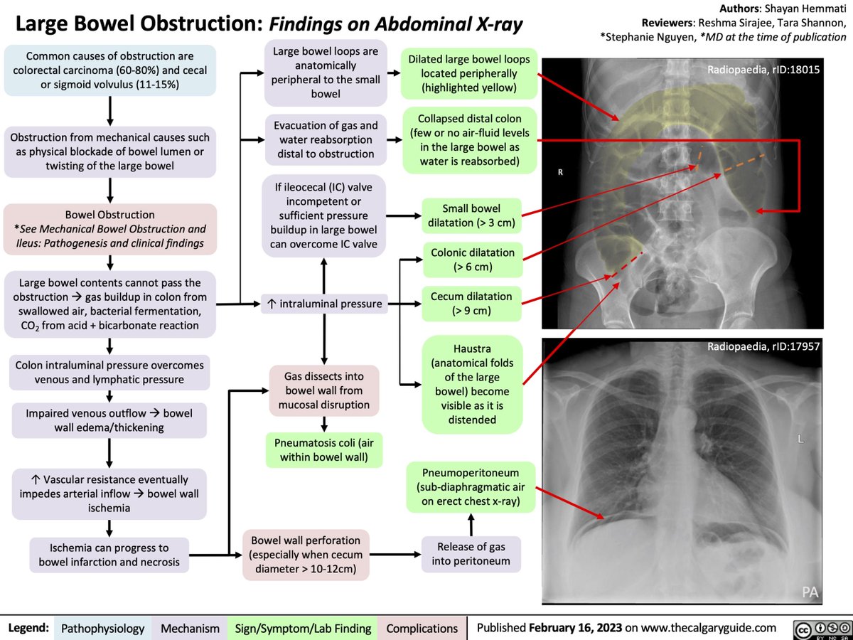 drkeithsiau's tweet photo. Large bowel obstruction - how to recognise it and the 3:6:9 rule 💡 https://t.co/4adTAW44S8