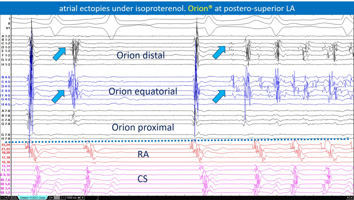 Arritmias_HRC's tweet photo. FOCAL AF due to extra-pulmonary TRIGGER... and they still ask us why we love our recording system ... #Epeeps https://t.co/mApJ2SRhV8