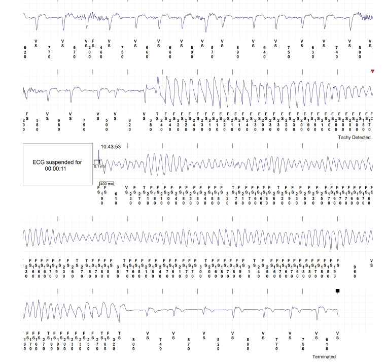 Rebecca Yapejian, MSN, FNP-C, FHRS, CCDS, AACC 🫀 tweet media