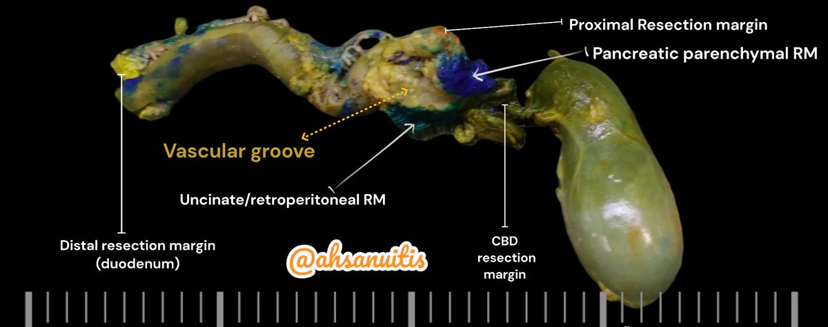 ahsanuitis's tweet image. Orientation of a  Whipple specimen on gross.  Here's an article that explains it's grossing quick well.
pubmed.ncbi.nlm.nih.gov/24451278/
#GIpath #GrossPath