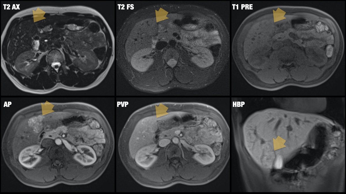 [2/2] Liver MRI is the way to go: T1/T2 isointense, avid arterial enhancement, 'fading' with surrounding liver, contrast uptake on hepatobiliary phase: benign focal nodular hyperplasia (FNH)! @BrighamRad @AURtweet @FOAMrad @SAR_RFS @futureradres @HarvardMacy @CBRadiologia #MedEd