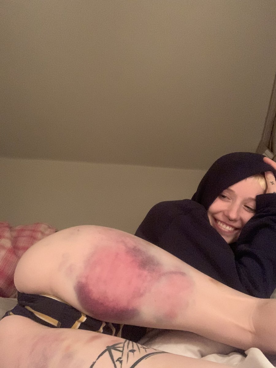 bruisecollector