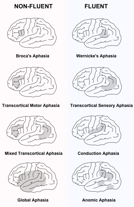Medical_MD1's tweet image. FlashNote📝

Aphasia🧠

Disturbance of language due to brain damage which affects comprehension (listening &amp;amp; reading) and/or expression (speaking &amp;amp; writing)

It’s divided into fluent or non-fluent. Then it’s divided by whether deficits in repetition, comprehension, and naming

.