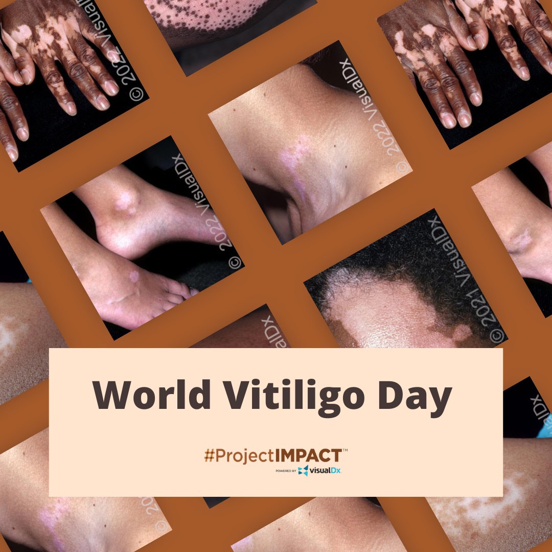ProjectIMPACT__'s tweet image. Vitiligo affects millions of individuals worldwide, and this day serves as a powerful platform to educate, advocate, and show solidarity with those living with this condition. Together, we can make a difference! 🤝
