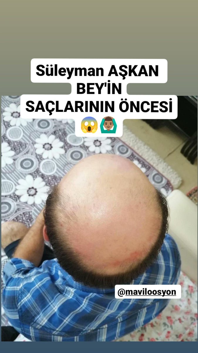 mavvilosyon's tweet photo. 🔥BAY-BAYAN SAÇ ÇIKARTAN SERUM 👍
⚡ 💯💯 GARANTİLİ LOSYON ⚡
✅ GÜÇSÜZ, CANSIZ
✅ ZAYIF
✅ SEYREK ve
✅ DÖKÜLEN SAÇLARINIZIN YENİDEN ÇIKSIN😎
👉Düzenli kullanımda 1-1,5 ayda %100 farkını görüyorsunuz
👉 Bir şişe 60 ml 1 ay gidiyor 👍
#herkes @herkes #kozmatik #losyon https://t.co/CQU2lYsM9l