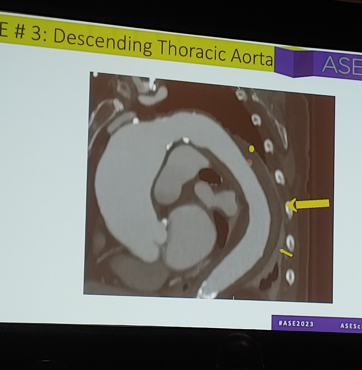 Patrick_Monette's tweet photo. Can you spot the abnormality? I'm no radiologist but these are tough to miss! Thanks to Dr. Basant Arya for sharing cases of enlarged aortic pathology. 
#ASE2023 https://t.co/unEk98Dmtz