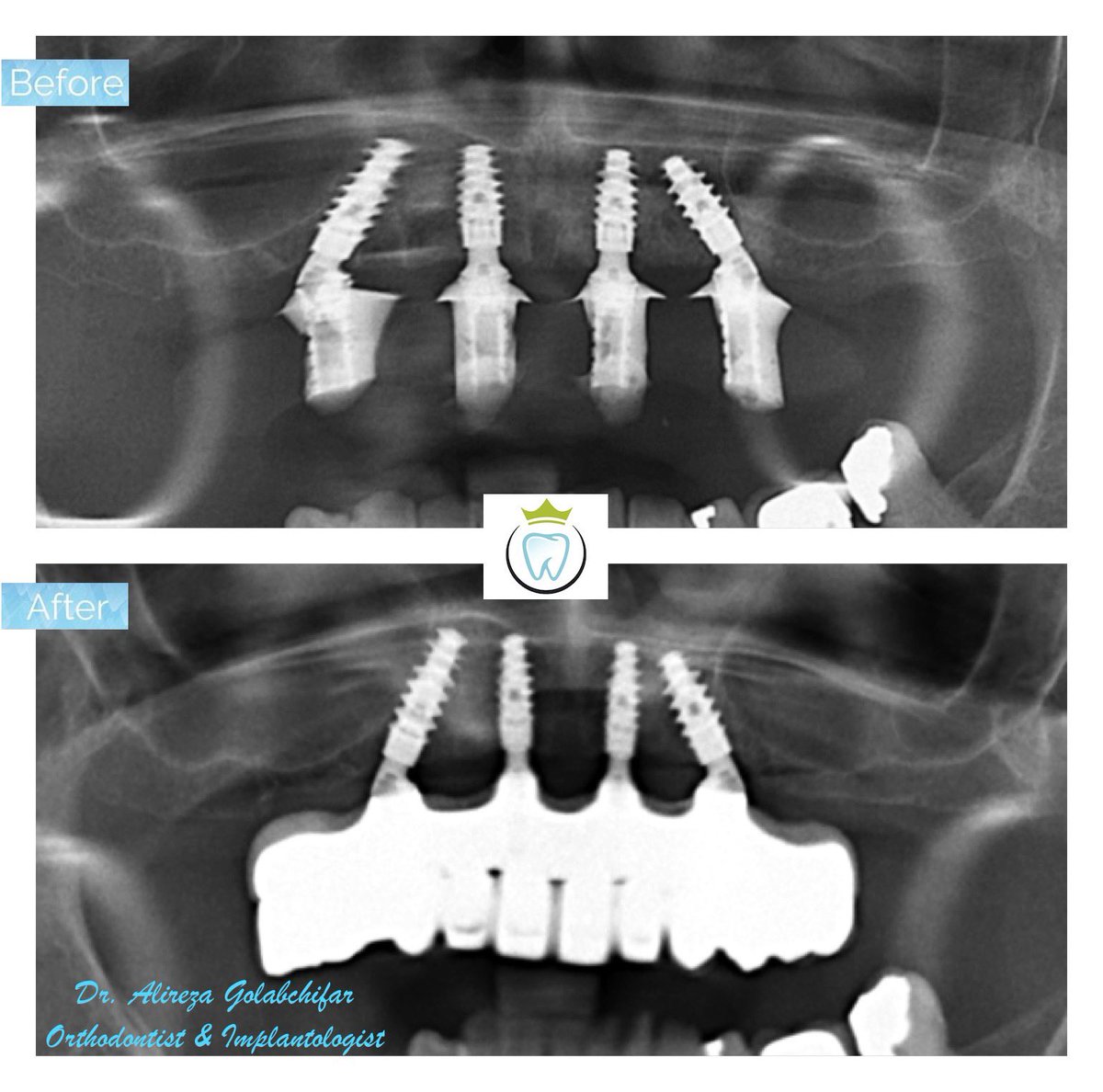 dentistry_king's tweet photo. All-On-4 implant-supported prosthesis.
Simultaneous extraction of all remaining teeth in the patient's upper arch, implant placement and temporization.
With All on four, she can now smile and eat again comfortably for the rest of her life!

#implant #immediateimplant https://t.co/WbJ5oT221m