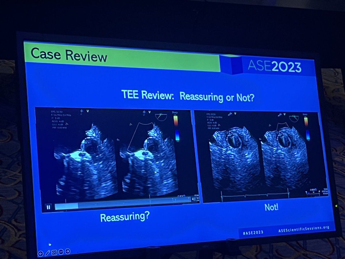 Multiplane #iecho tee needed to see seating and even then challenging . ⁦⁦@pravinp8⁩ outlining importance of #mmi #yesCCT approach. 2D #ice inadequate for cases. Maybe 3D with expert operator and #iecho expert combined ⁦@tiffchenMD⁩ ⁦@purviparwani⁩ ⁦