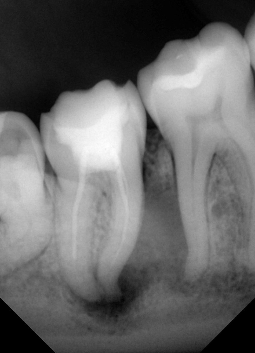 Drm7sin's tweet photo. #47 : previously treated \ Symptomatic apical periodontist. 
Non surgical re-treatment was done 

3 months follow up visit shows very good healing process 🌟 https://t.co/YP4G8LX3nv