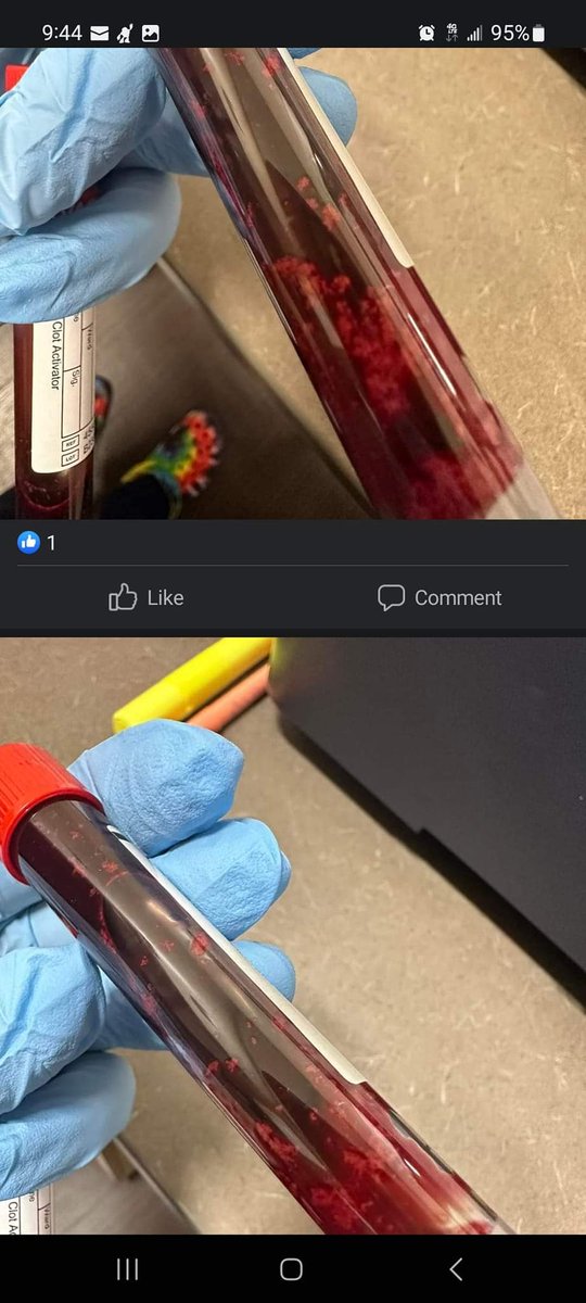 A friend of mine that works at the local hospital posted this on FB. This post was from a Phlebotomy FB group. She had trouble drawing a man's blood, cause the needle kept getting clogged& inside the tubes  of blood, there's something  floating around.  I bet money he is vaxxed.